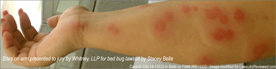 picture of bed bug bite used in lawsuit