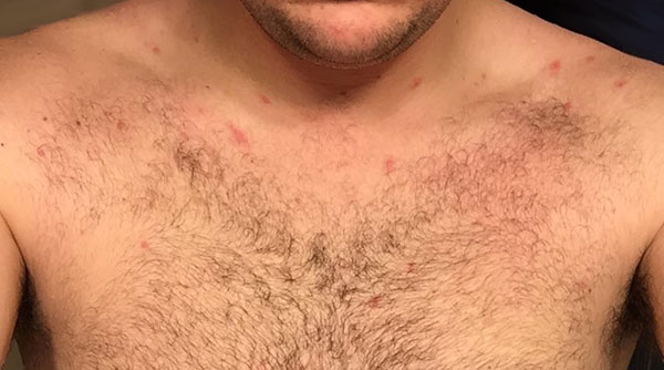 picture of what my bed bug bites look like after staying at a hotel